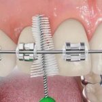 Деминерализация зубов при ношении брекетов