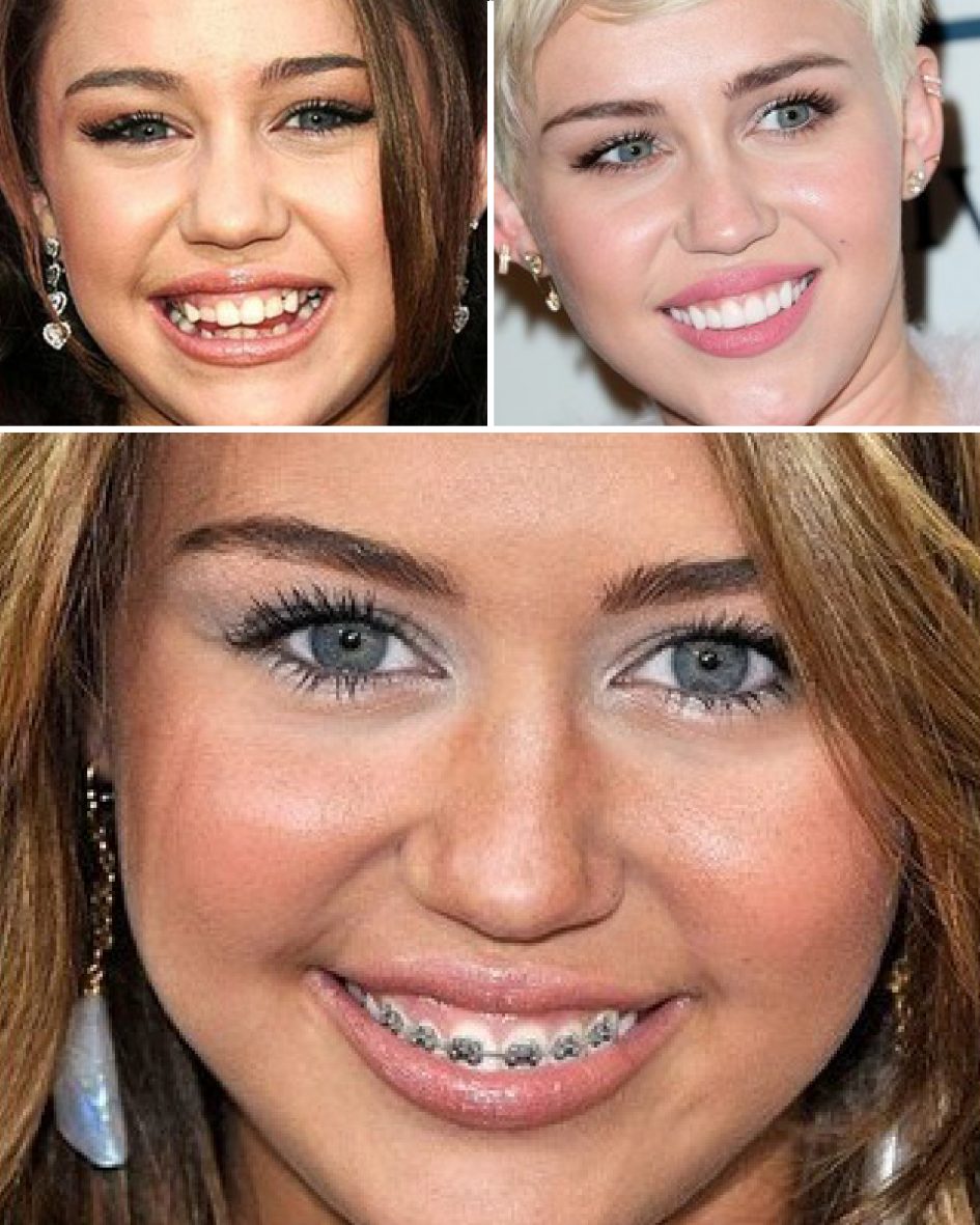фото исправленных зубов