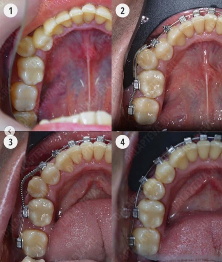 Как работают брекеты? — О брекетах от ортодонта
